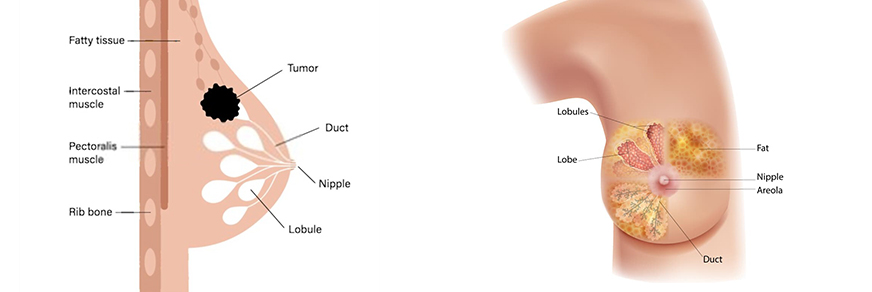 Breast Cancer Treatment Dubai