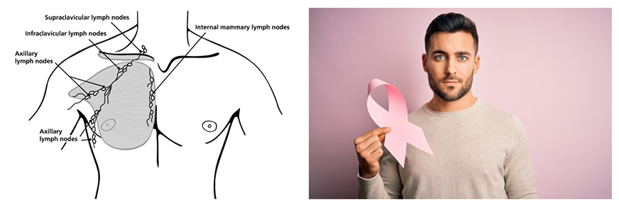 Breast Cancer in Men