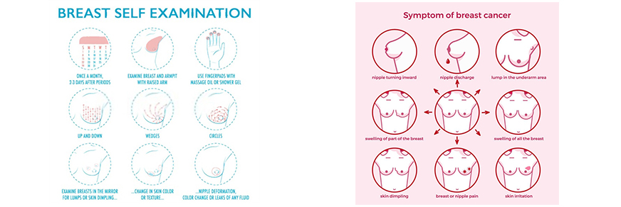 What Are the Symptoms of Breast Cancer?